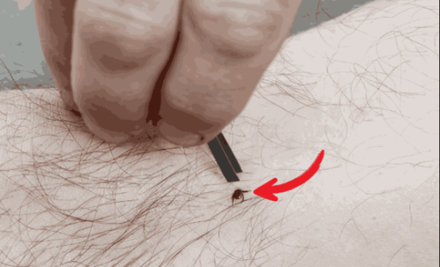 Evo kako pravilno ukloniti krpelja i šta nikada ne smijete raditi prilikom uklanjanja!