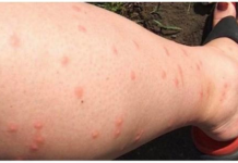 KOMARCI VAM PRAVE PAKAO OD ŽIVOTA? Samo isijecite OVO VOĆE na pola i ostavite u sobi, VIŠE IH NIKADA NEĆETE VIDJETI BLIZU!