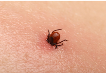 Bezbolno je i nema čupanja: Doktorka otkrila trik kako da se krpelj sam otkači sa kože (video)