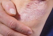 NE BACAJTE NI SLUČAJNO KORU OD OVE VOĆKE: Liječi Psorijazu, Skida Bradavice I Izbjeljuje Zube!