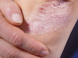 NE BACAJTE NI SLUČAJNO KORU OD OVE VOĆKE: Liječi Psorijazu, Skida Bradavice I Izbjeljuje Zube!