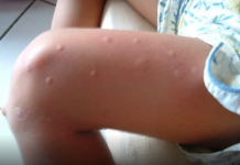 KOMARCI VAM PRAVE PAKAO OD ŽIVOTA? Samo isijecite OVO VOĆE na pola i ostavite u sobi, VIŠE IH NIKADA NEĆETE VIDJETI BLIZU!