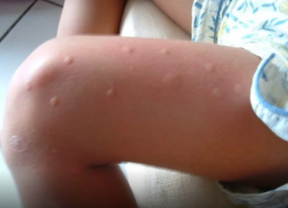 KOMARCI VAM PRAVE PAKAO OD ŽIVOTA? Samo isijecite OVO VOĆE na pola i ostavite u sobi, VIŠE IH NIKADA NEĆETE VIDJETI BLIZU!