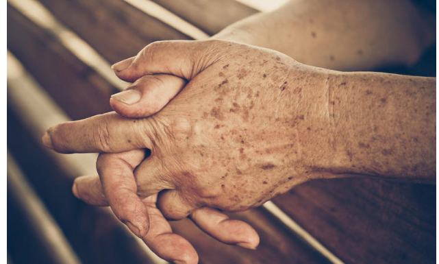 PRIMJETILI STE DA VAM SE POJAVLJUJU STARAČKE PJEGE : To je znak da imate ozbiljan problem sa jednim organom!