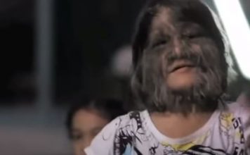 DEVOJKA SA LICEM MAJMUNA SE UDALA PA OBRIJALA LICE: Kada su je videli, ljudi se šokirali! Pogledajte kako SADA IZGLEDA