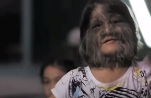 DEVOJKA SA LICEM MAJMUNA SE UDALA PA OBRIJALA LICE: Kada su je videli, ljudi se šokirali! Pogledajte kako SADA IZGLEDA