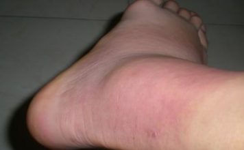 OSLOBODITE ZGLOBOVE OD NAGOMILANE SOLI: Magičan rastvor ruskog travara za 2 sedmice potpuno oporavlja koštani sistem