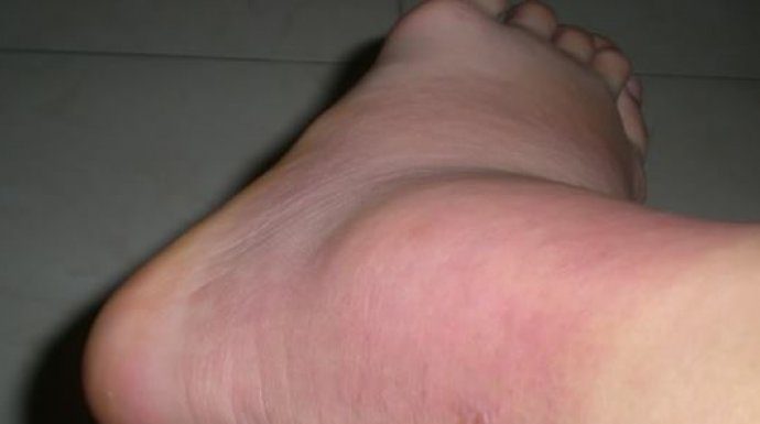 OSLOBODITE ZGLOBOVE OD NAGOMILANE SOLI: Magičan rastvor ruskog travara za 2 sedmice potpuno oporavlja koštani sistem