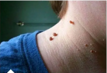 NERVIRAJU VAS SITNE BRADAVICE NA KOŽI? Evo kako da ih brzo uklonite, treba vam samo jedna namirnica!