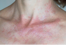 Zašto me tijelo svrbi nakon tuširanja Ako i vi imate crvene mrlje, evo zašto..