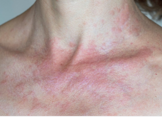 Zašto me tijelo svrbi nakon tuširanja Ako i vi imate crvene mrlje, evo zašto..