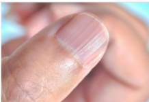 IMATE LI OVAKVE IZBOČINE NA NOKTIMA – evo šta one znače: Doktorica otkrila i možda ćete se iznenaditi