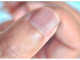 IMATE LI OVAKVE IZBOČINE NA NOKTIMA – evo šta one znače: Doktorica otkrila i možda ćete se iznenaditi