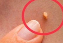 NADALEKO PRIZNATI NARODNI LIJEK ZA LIJEČENJE BRADAVICA JE NITKO DRUGI DO TRAVA RUSA