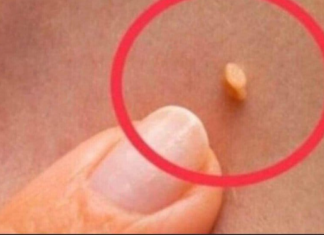 NADALEKO PRIZNATI NARODNI LIJEK ZA LIJEČENJE BRADAVICA JE NITKO DRUGI DO TRAVA RUSA