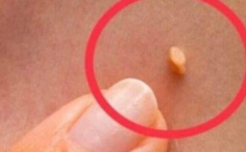 NADALEKO PRIZNATI NARODNI LIJEK ZA LIJEČENJE BRADAVICA JE NITKO DRUGI DO TRAVA RUSA