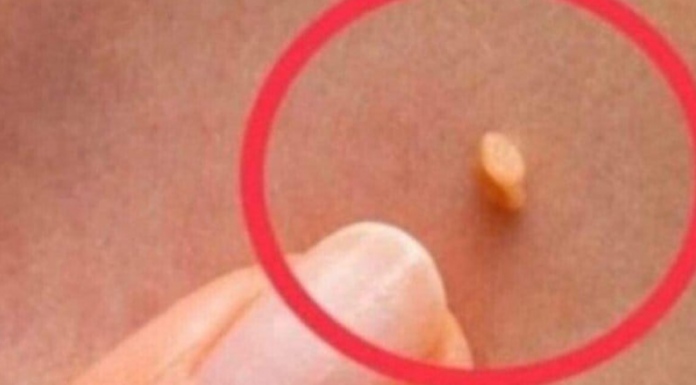 NADALEKO PRIZNATI NARODNI LIJEK ZA LIJEČENJE BRADAVICA JE NITKO DRUGI DO TRAVA RUSA