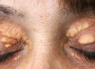 STAVILA SAM OVU NAMIRNICU NA MASNO TKIVO KOD OKA, ono je preko noći nestalo: EVO ŠTA ME SPASILO, SVI GA IMATE U KUĆI