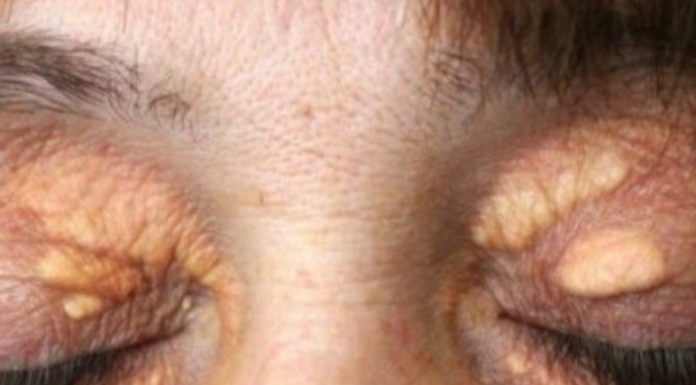 STAVILA SAM OVU NAMIRNICU NA MASNO TKIVO KOD OKA, ono je preko noći nestalo: EVO ŠTA ME SPASILO, SVI GA IMATE U KUĆI