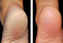 ZA MEKA STOPALA POTREBNA SU VAM SAMO 3 SASTOJKA IZ KUHINJE: Potopite noge u ovu smjesu na 15 minuta i recite zbogom ispucalim petama