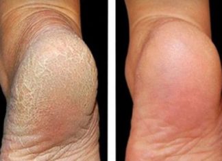 ZA MEKA STOPALA POTREBNA SU VAM SAMO 3 SASTOJKA IZ KUHINJE: Potopite noge u ovu smjesu na 15 minuta i recite zbogom ispucalim petama