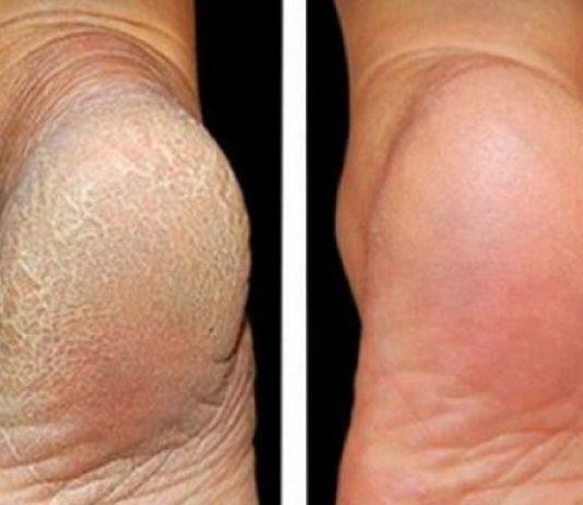 ZA MEKA STOPALA POTREBNA SU VAM SAMO 3 SASTOJKA IZ KUHINJE: Potopite noge u ovu smjesu na 15 minuta i recite zbogom ispucalim petama