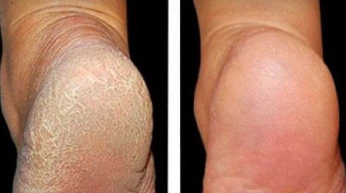 ZA MEKA STOPALA POTREBNA SU VAM SAMO 3 SASTOJKA IZ KUHINJE: Potopite noge u ovu smjesu na 15 minuta i recite zbogom ispucalim petama