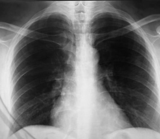 OD GNOJENJA DO OTKAZIVANJA ORGANA! Ovo su glavni simptomi UPALE PLUĆA! Odnela i slavnu OSKAROVKU