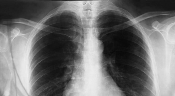 OD GNOJENJA DO OTKAZIVANJA ORGANA! Ovo su glavni simptomi UPALE PLUĆA! Odnela i slavnu OSKAROVKU