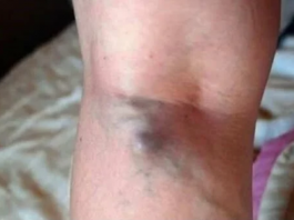 NAMIRNICE KOJE POVEĆAVAJU RIZIK OD TROMBOZE, JEDNA POSEBNO: Jedemo ih svakoga dana, a štete arterijama