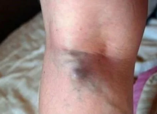 NAMIRNICE KOJE POVEĆAVAJU RIZIK OD TROMBOZE, JEDNA POSEBNO: Jedemo ih svakoga dana, a štete arterijama