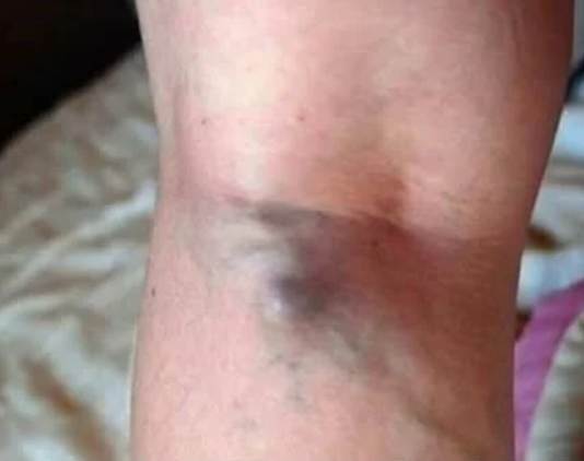 NAMIRNICE KOJE POVEĆAVAJU RIZIK OD TROMBOZE, JEDNA POSEBNO: Jedemo ih svakoga dana, a štete arterijama