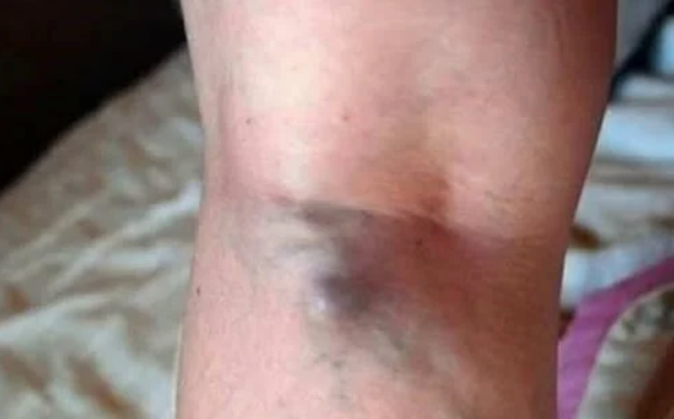 NAMIRNICE KOJE POVEĆAVAJU RIZIK OD TROMBOZE, JEDNA POSEBNO: Jedemo ih svakoga dana, a štete arterijama