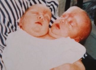 Te ’88. rodila se devojčica sa 2 glave: Roditelji se kajali dok su živi zbog odluke da je operišu, evo kako je živela