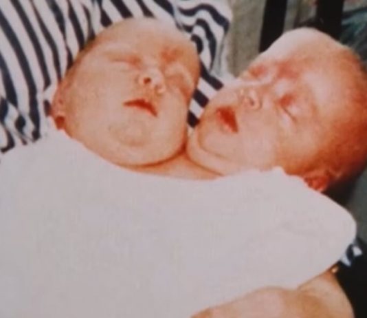 Te ’88. rodila se devojčica sa 2 glave: Roditelji se kajali dok su živi zbog odluke da je operišu, evo kako je živela