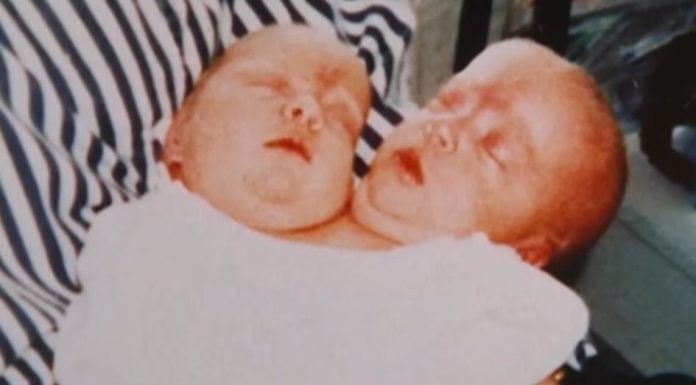 Te ’88. rodila se devojčica sa 2 glave: Roditelji se kajali dok su živi zbog odluke da je operišu, evo kako je živela