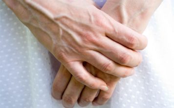 VENE SU VAM ISPUPČENE? 8 razloga zašto se to događa I KADA TREBATE POTRAŽITI DOKTORA!