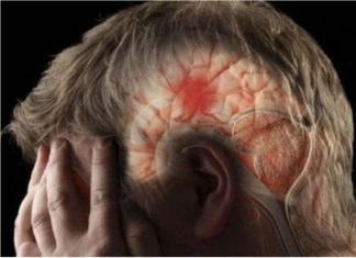 80 posto moždanih udara može se spriječiti: NEUROLOGINJA OTKRILA KAKO