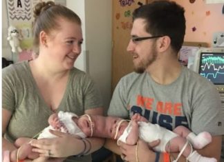 Sijamske bliznakinje rođene su s povezanim glavama, ali su ih lekari uspeli razdvojiti: kako devojčice žive danas.