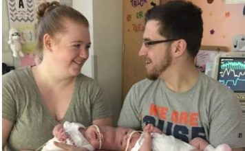 Sijamske bliznakinje rođene su s povezanim glavama, ali su ih lekari uspeli razdvojiti: kako devojčice žive danas.