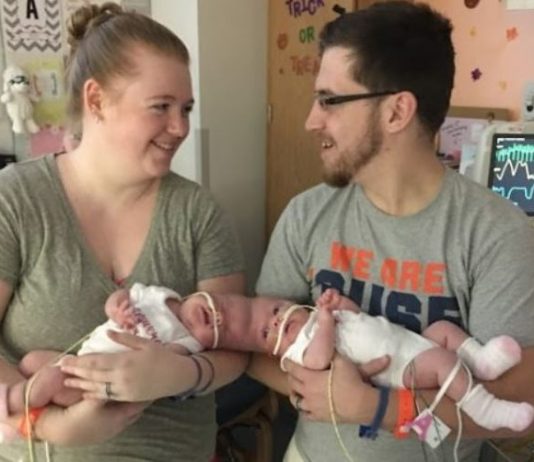 Sijamske bliznakinje rođene su s povezanim glavama, ali su ih lekari uspeli razdvojiti: kako devojčice žive danas.