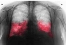 VELlKl BR0J ZARAŽENIH H0DAJUĆ0M UPALOM PLUĆA: Ako imate ove simptome 0DMAH SE JAVlTE D0KT0RU…