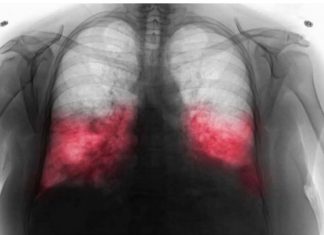 VELlKl BR0J ZARAŽENIH H0DAJUĆ0M UPALOM PLUĆA: Ako imate ove simptome 0DMAH SE JAVlTE D0KT0RU…