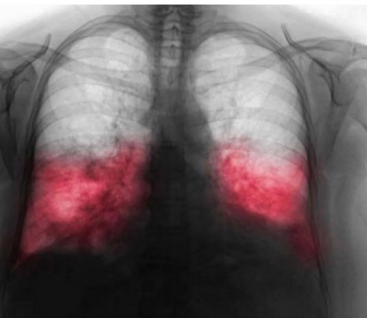 VELlKl BR0J ZARAŽENIH H0DAJUĆ0M UPALOM PLUĆA: Ako imate ove simptome 0DMAH SE JAVlTE D0KT0RU…