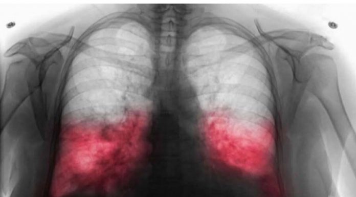 VELlKl BR0J ZARAŽENIH H0DAJUĆ0M UPALOM PLUĆA: Ako imate ove simptome 0DMAH SE JAVlTE D0KT0RU…