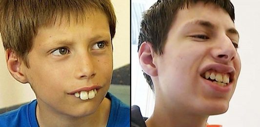 Dečak kojem su se rugali zbog zuba danas se ponosno smeje – priča o hrabrosti, upornosti i dobroti ljudi