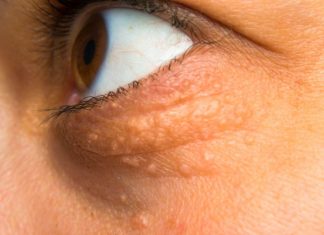 STAVILA SAM OVU NAMIRNICU NA MASNO TKIVO KOD OKA, ono je preko noći nestalo: EVO ŠTA ME SPASILO, SVI GA IMATE U KUĆI