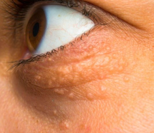 STAVILA SAM OVU NAMIRNICU NA MASNO TKIVO KOD OKA, ono je preko noći nestalo: EVO ŠTA ME SPASILO, SVI GA IMATE U KUĆI