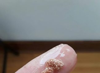 Bele grudvice u jajetu: šta to zaista znači i da li treba da brinete?