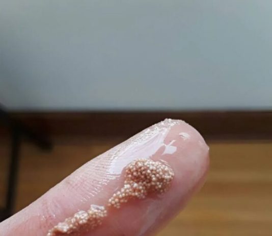 Bele grudvice u jajetu: šta to zaista znači i da li treba da brinete?